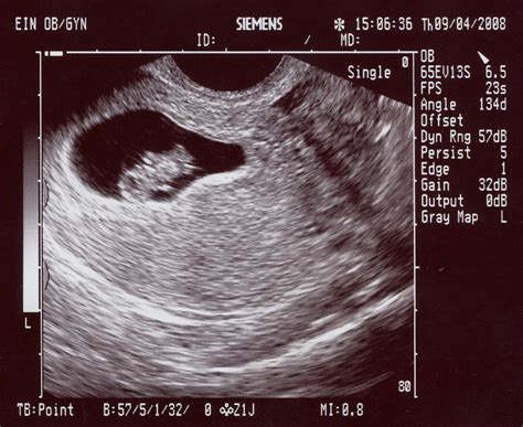 sonogram prank|create your own ultrasound picture.